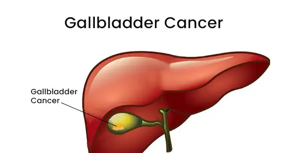 gallstone risks and complications