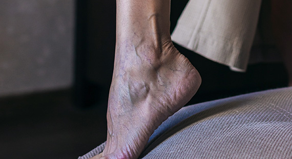 varicose veins risks and complications