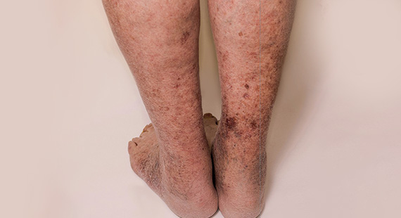 deep vein thrombosis risks and complications
