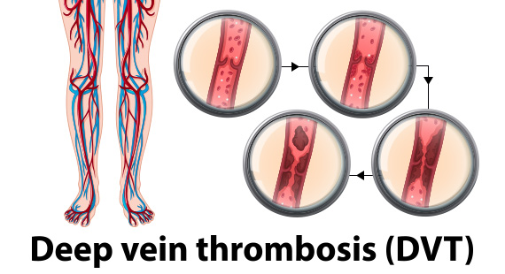 what is deep vein thrombosis