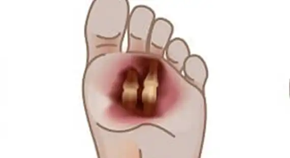 diabetic foot ulcers risks and complications