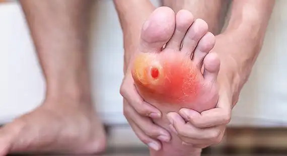 diabetic foot ulcers symptoms