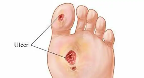 what is diabetic foot ulcers