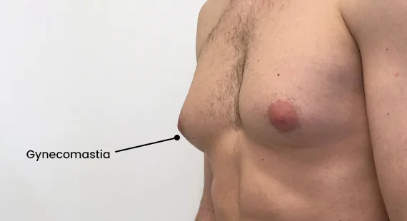 Can Gynecomastia Go Away with Exercise?