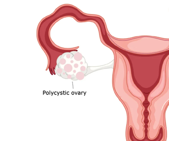 pcod-pcos