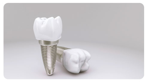 dental implant services