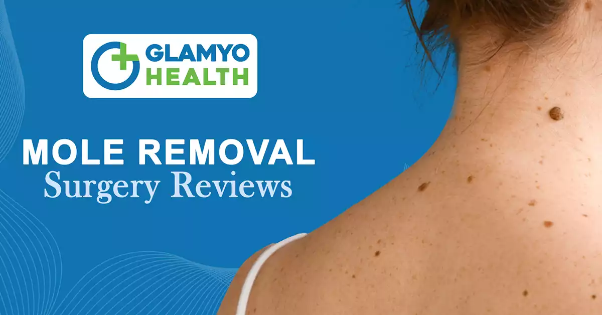 mole removal surgery reviews 