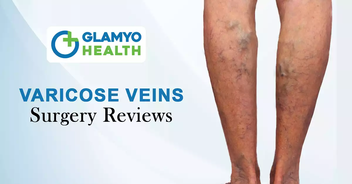 varicose veins surgery reviews 