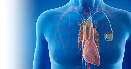 PACEMAKER IMPLANTATION SURGERY IN Delhi NCR